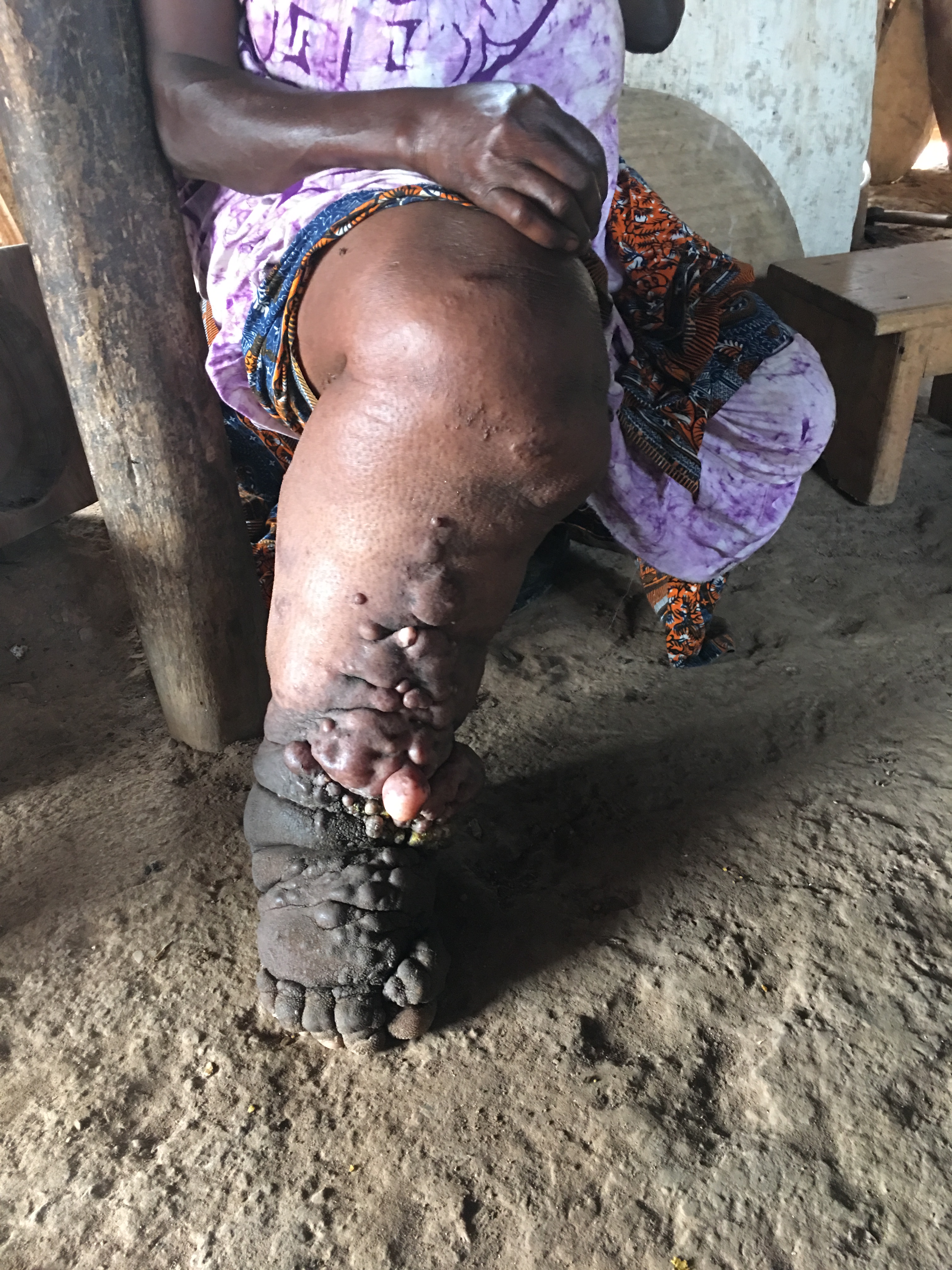 Woman with lymphedema close up.JPG